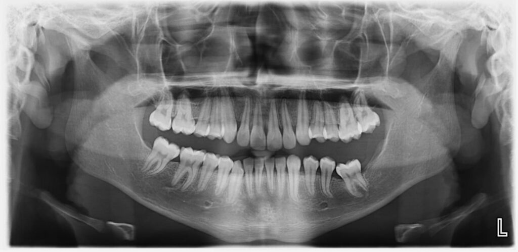Radiografías Intraorales